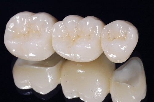 Bọc răng sứ không kim loại có nên không? 1 Bọc răng sứ không kim loại có nên không? 1