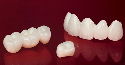 Răng toàn sứ venus có tác dụng gì? 1 Răng toàn sứ venus có tác dụng gì? 1