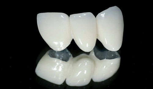 Bọc răng sứ Venus là phương pháp như thế nào? 2 Bọc răng sứ Venus là phương pháp như thế nào? 2