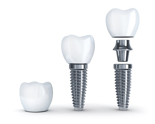 Cách khắc phục tình trạng mất răng 1 Cách khắc phục tình trạng mất răng 1