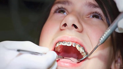 Có phải nhổ răng khi niềng răng không? 2 Có phải nhổ răng khi niềng răng không? 2