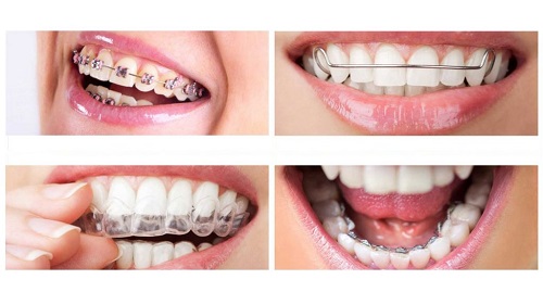 Niềng răng sẽ đem lại kết quả gì? 2 Niềng răng sẽ đem lại kết quả gì? 2