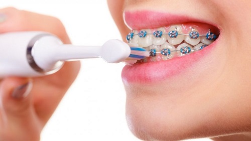 Tư vấn về vấn đề niềng răng nha khoa 3 Tư vấn về vấn đề niềng răng nha khoa 3