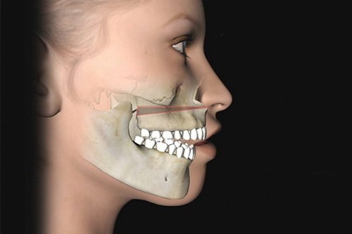 Giải đáp thắc mắc về niềng răng hô 2 Giải đáp thắc mắc về niềng răng hô 2