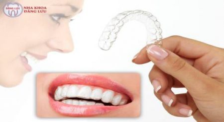 Ưu điểm của niềng răng không mắc cài Invisalign