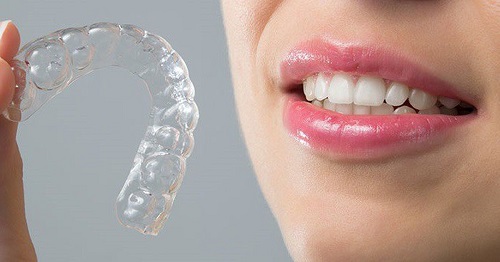 Niềng răng không mắc cài có tác dụng gì? 3 Niềng răng không mắc cài có tác dụng gì? 3