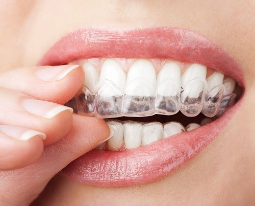 Niềng răng không mắc cài có tốt không? 1 Niềng răng không mắc cài có tốt không? 1