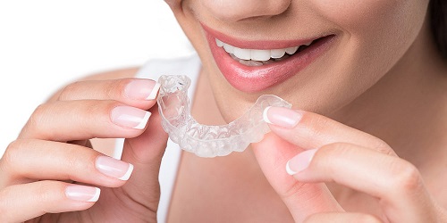 Thông tin cơ bản về niềng răng không mắc cài 2 Thông tin cơ bản về niềng răng không mắc cài 2