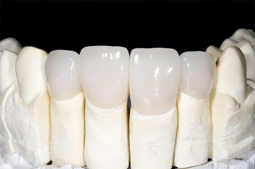 Bọc răng sứ nào tốt? 2 Bọc răng sứ nào tốt? 2