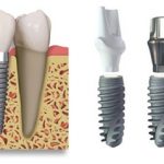 Có nên trồng răng với implant ?