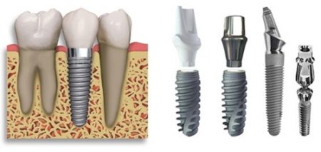 Có nên trồng răng với implant ?