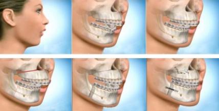 Quy trình phẫu thuật hàm hô như thế nào ? 2 Quy trình phẫu thuật hàm hô như thế nào ? 3