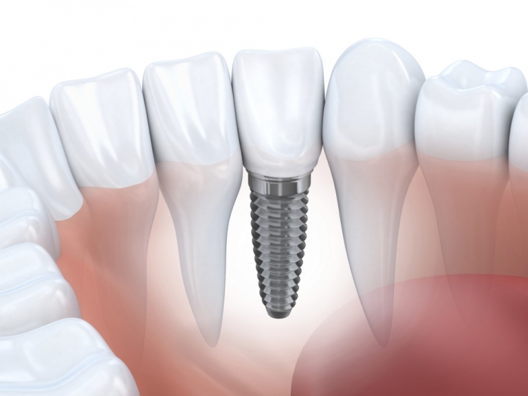  Quy trình cắm ghép răng Implant-3