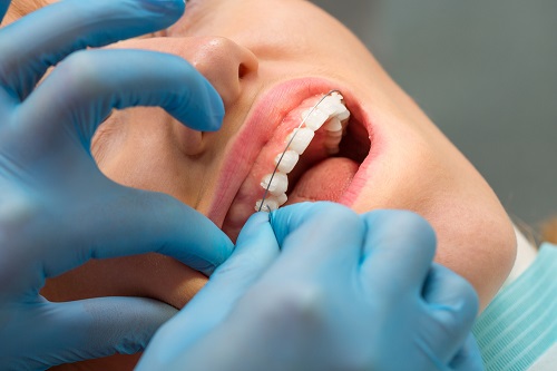 Kĩ thuật niềng răng hô như thế nào? 2 Kĩ thuật niềng răng hô như thế nào? 2