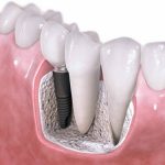 Có tốt không khi cấy ghép răng Implant ?