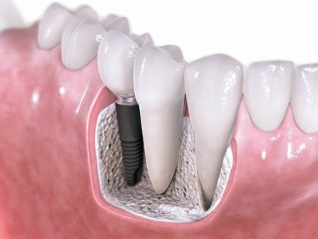 Có tốt không khi cấy ghép răng Implant ?