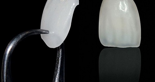 Nên thực hiện dán mặt sứ Veneer khi nào? 1 Nên thực hiện dán mặt sứ Veneer khi nào? 1