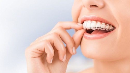 Tác dụng niềng răng không mắc cài 1 Tác dụng niềng răng không mắc cài 1