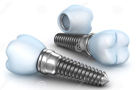 Cấy ghép răng Implant có ích lợi gì? 2 Cấy ghép răng Implant có ích lợi gì? 2