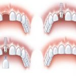Cấy ghép răng Implant có ích lợi gì? 1
