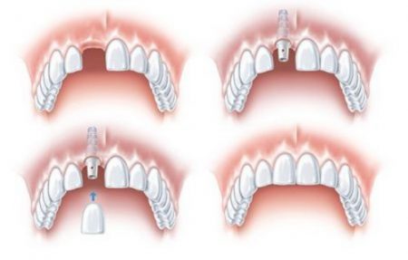 Cấy ghép răng Implant có ích lợi gì? 1 Cấy ghép răng Implant có ích lợi gì? 1