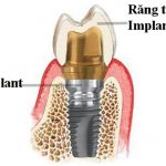 Cấy Implant quy trình thực hiện như thế nào ?