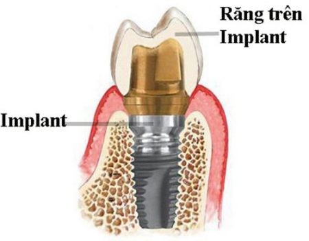 Cấy Implant quy trình thực hiện như thế nào ?