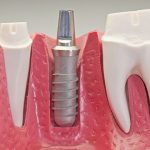 Chi phí trồng răng implant bao nhiêu -1