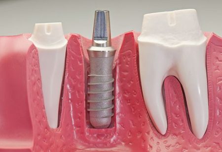 Chi phí trồng răng implant bao nhiêu -1