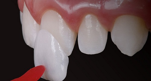 Dán răng sứ veneer hiện nay rất phổ biến 1 Dán răng sứ veneer hiện nay rất phổ biến 1