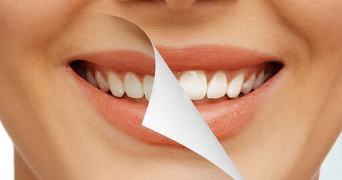 Dán răng sứ veneer hiện nay rất phổ biến 3 Dán răng sứ veneer hiện nay rất phổ biến 3