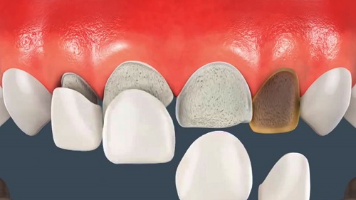 Dán răng sứ Veneer phục hình thẩm mỹ hàm răng 1 Dán răng sứ Veneer phục hình thẩm mỹ hàm răng 1