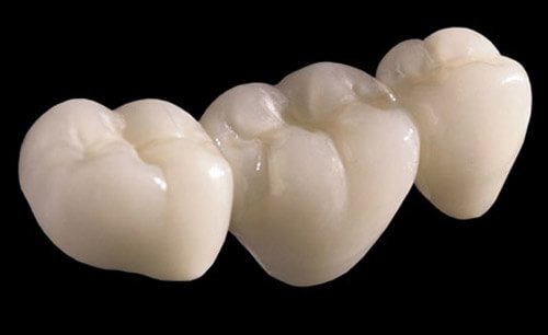 Răng răng sứ Cercon có độ bền như thế nào? 1 Răng răng sứ Cercon có độ bền như thế nào? 1