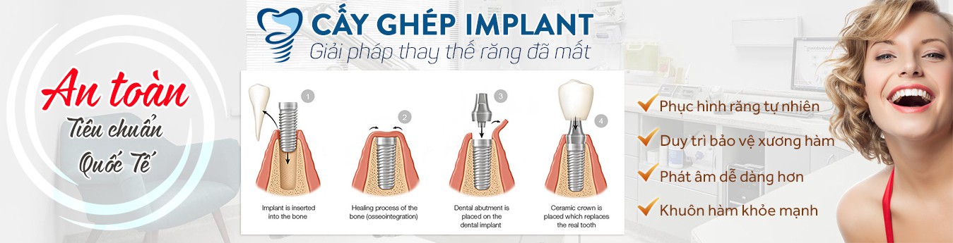 Cấy ghép Implant giải pháp thay thế răng đã mất slider