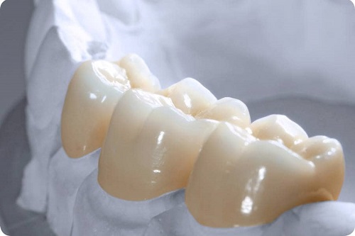 Bọc răng sứ có duy trì được lâu không? 2 Bọc răng sứ có duy trì được lâu không? 2