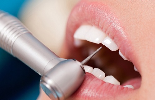 Có nên bọc răng sứ không kim loại? 3 Có nên bọc răng sứ không kim loại? 3