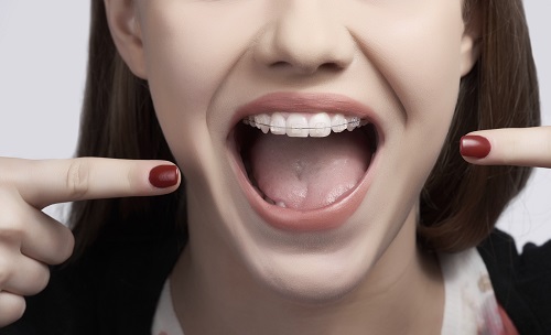 Tác dụng quan trọng của niềng răng hô 3 Tác dụng quan trọng của niềng răng hô 3