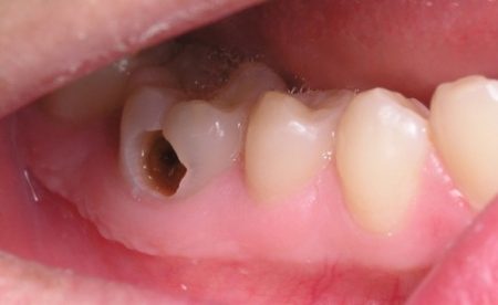 Có thể tẩy trắng răng sâu được không? 3 Có thể tẩy trắng răng sâu được không? 3