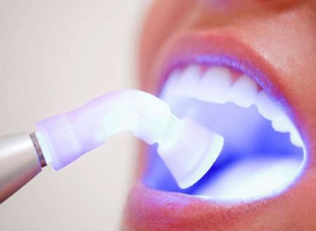 Tẩy trắng răng bằng Laser bao nhiêu tiền? 2 Tẩy trắng răng bằng Laser bao nhiêu tiền? 2