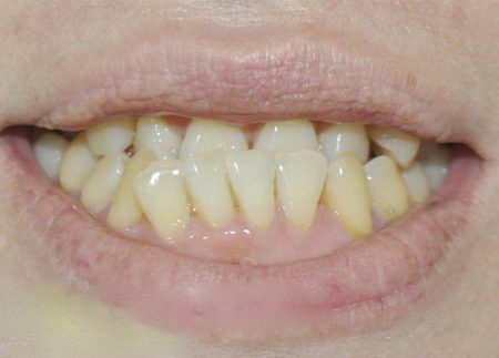 Tẩy trắng răng vĩnh viễn có được không? 1 Tẩy trắng răng vĩnh viễn có được không? 1