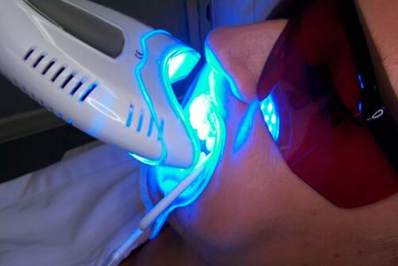 Tẩy trắng răng vĩnh viễn có được không? 2 Tẩy trắng răng vĩnh viễn có được không? 2