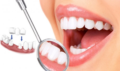Răng đều đẹp nhờ giải pháp bọc răng sứ cho răng hô 2 Răng đều đẹp nhờ giải pháp bọc răng sứ cho răng hô 2