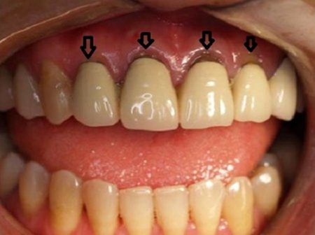 Bọc răng sứ có bị hôi miệng không? Nguyên nhân và cách khắc phục 2
