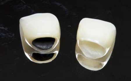 3 cách để biết bọc răng sứ loại nào tốt nhất 1 3 cách để biết bọc răng sứ loại nào tốt nhất 1