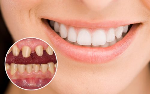 3 cách để biết bọc răng sứ loại nào tốt nhất 2 3 cách để biết bọc răng sứ loại nào tốt nhất 2