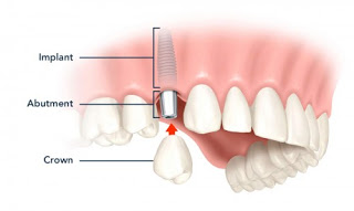 Cắm implant răng cửa như thế nào? 3