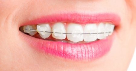 Niềng răng 1 hàm có được không? Cần lời giải đáp 1