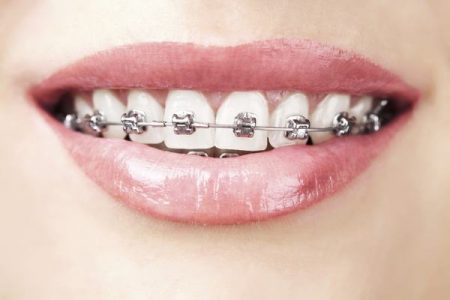 Niềng răng 1 hàm có được không? Cần lời giải đáp 2