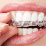 Tìm hiểu về niềng răng không mắc cài clear aligner