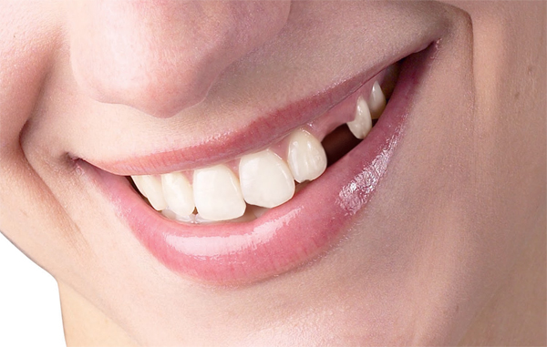 Bác sĩ tư vấn - Trồng răng hàm có đau không 1 Bác sĩ tư vấn - Trồng răng hàm có đau không 1